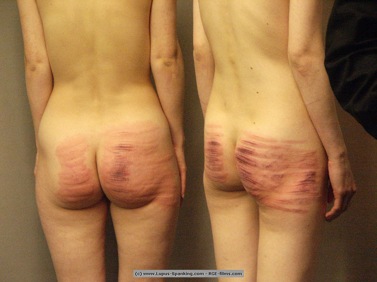 Caning Welts - Lupus Spanking | Caning